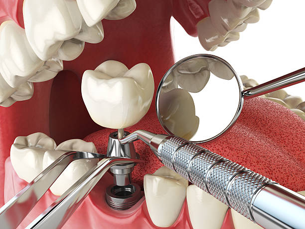 Best Emergency Root Canal Treatment in Rockmart, GA